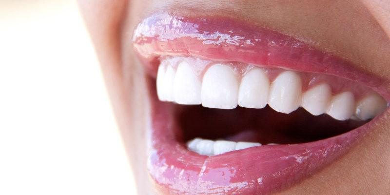 six-month-smiles-braces